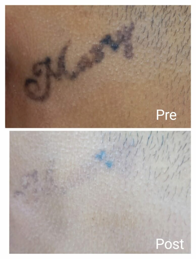 نتيجة ٣ جلسات لازالة الوشم بالليزر